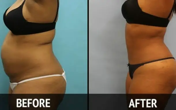 liposuction