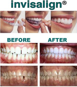 Invisalign Before and After