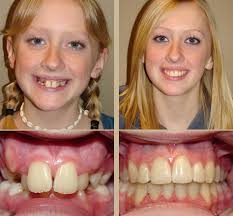 Invisalign Before and After