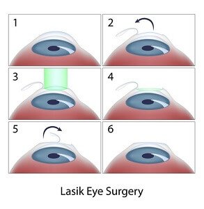 LASIK eye surgery explained