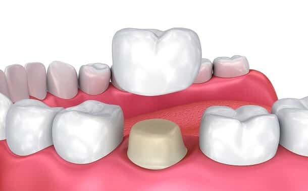 Dental Crown Cost