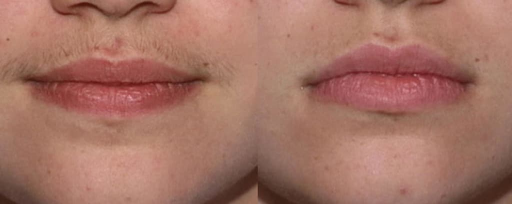 Laser_hair_removal_of_Lip