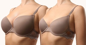 Breast Reduction Example