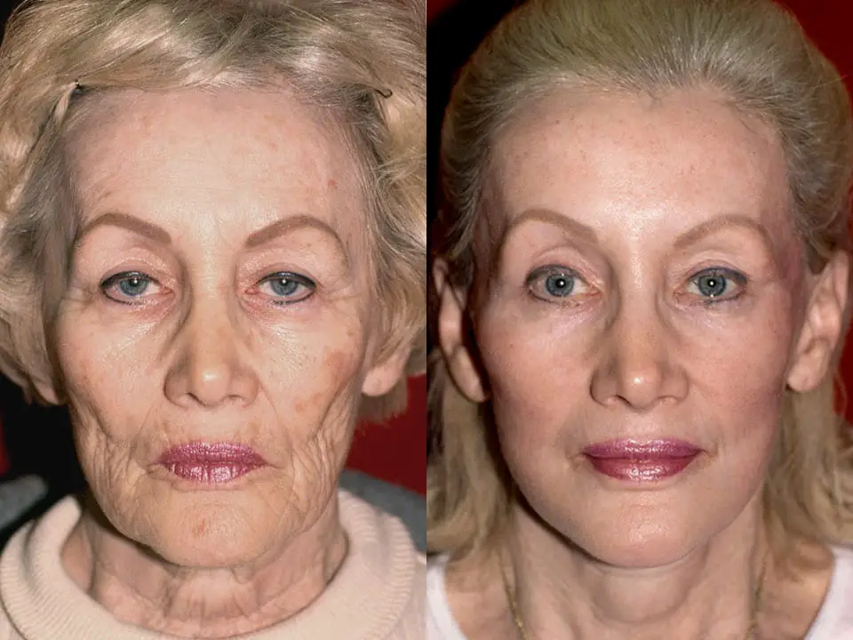 How Much Does A Facelift Cost? ThePricer Media