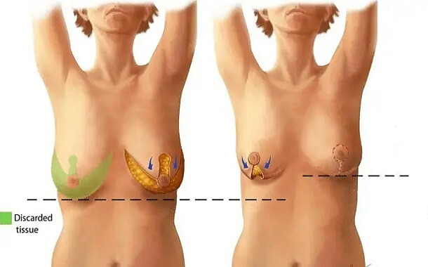 Breast Reduction Surgery Cost