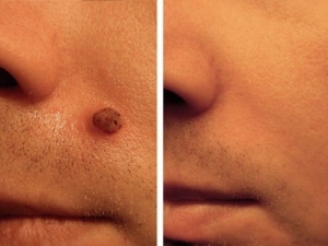 Before-after-mole removal