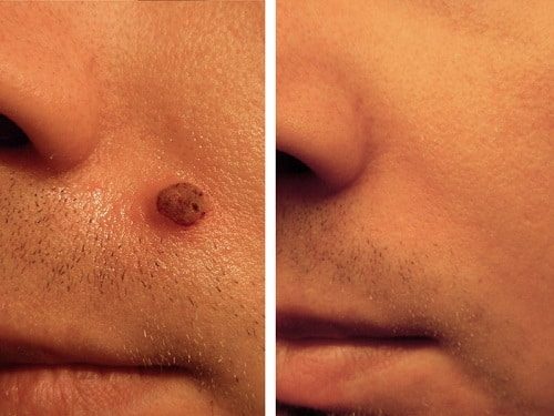 Before and After Mole Removal
