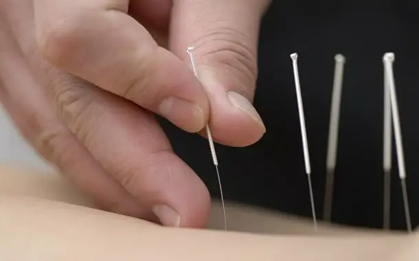 acupuncture-needles