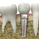 dental implant cost