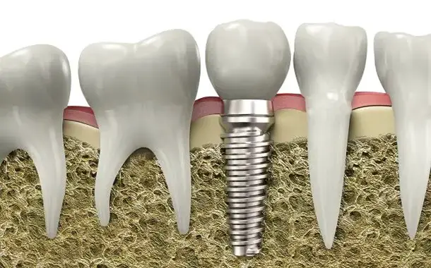 dental implant cost