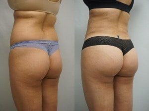 Buttock Augmentation Before and After