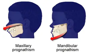 Jaw surgeries