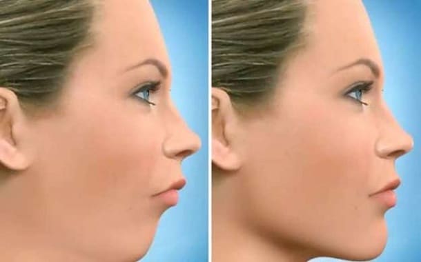 Jaw Surgery Price