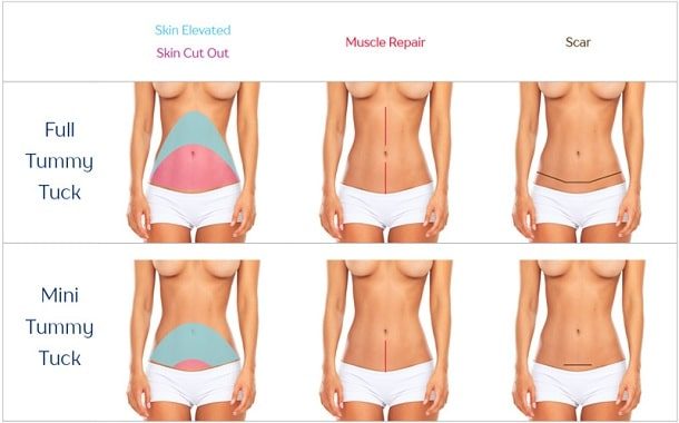 Mini Tummy Tuck Cost