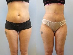 Mini tummy tuck patient