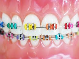 Colored Braces