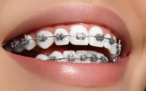 Cost of Braces