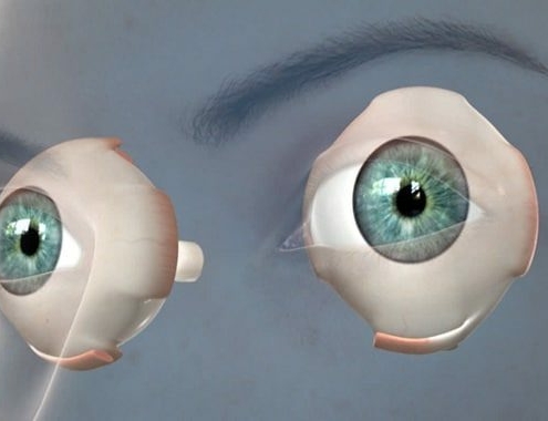 Lazy Eye Or Strabismus Surgery Cost In 21 The Pricer Lazy Eye Or Strabismus Surgery Cost In 21 The Pricer