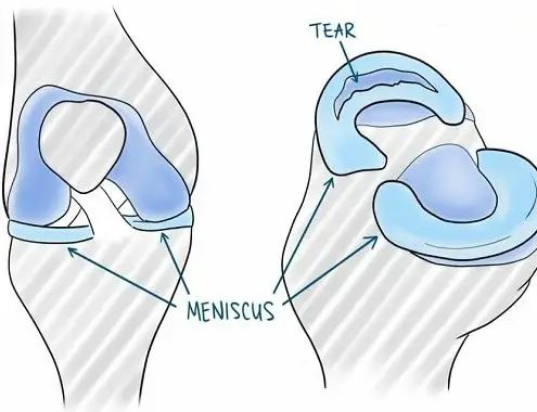 meniscus-tear-surgery-cost