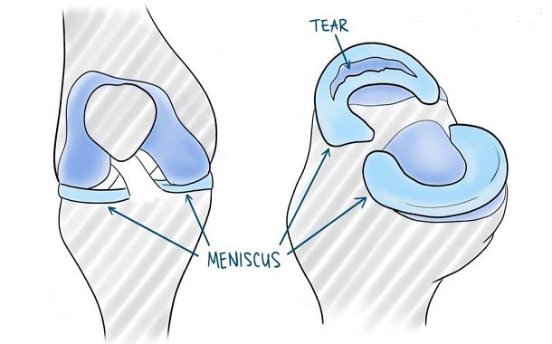 meniscus-tear-surgery-cost