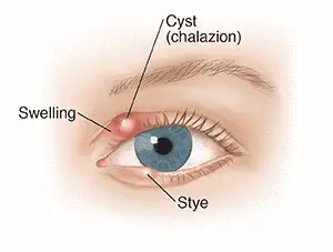 Chalazion Explained