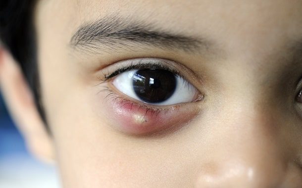 CHalazion Surgery Cost