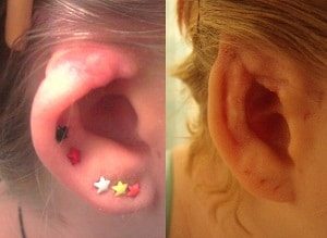 Elf Ear Surgery Before and After