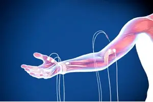 had emg test done still in pain after microdiscectomy had emg test done still in pain after microdiscectomy