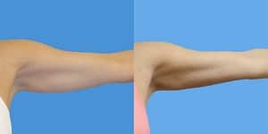 Before and After Arm Liposuction