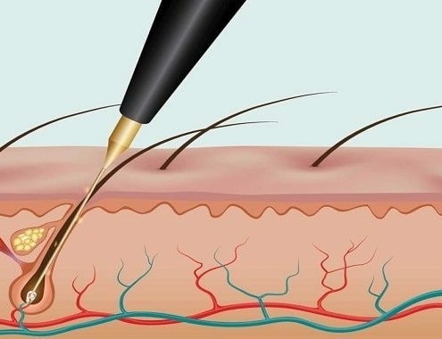 Electrolysis Cost