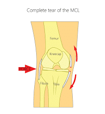 MCL tear