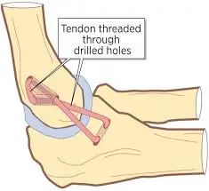 Tommy John Surgery Explained