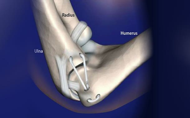 Tommy John Surgery Cost