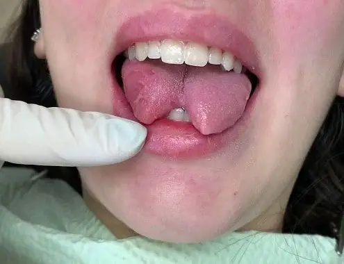 Tongue Splitting Cost