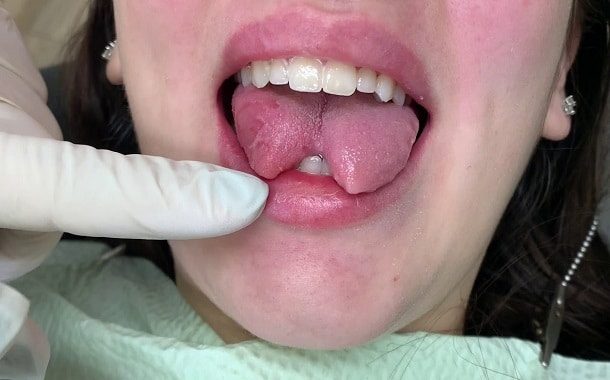 Tongue Splitting Cost