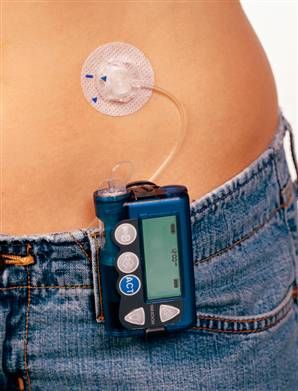 Insulin Pump on Belt