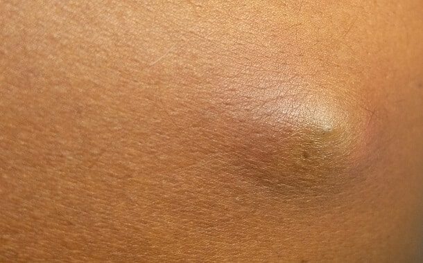 Sebaceous Cyst Removal Cost