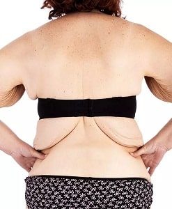 Post Weight Loss Excess Skin