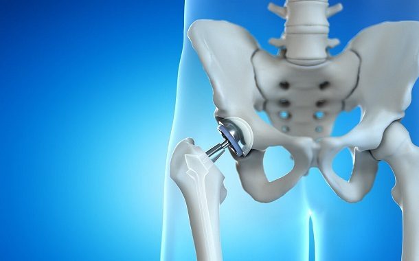 Hip Replacement Cost