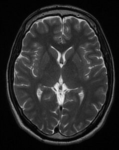 MR Image of the Brain