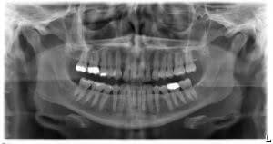 Panoramic Dental X-Ray Example