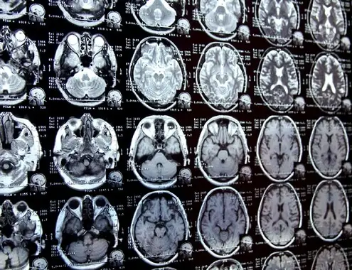 Brain MRI Cost