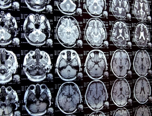 Brain MRI Cost Brain MRI Cost