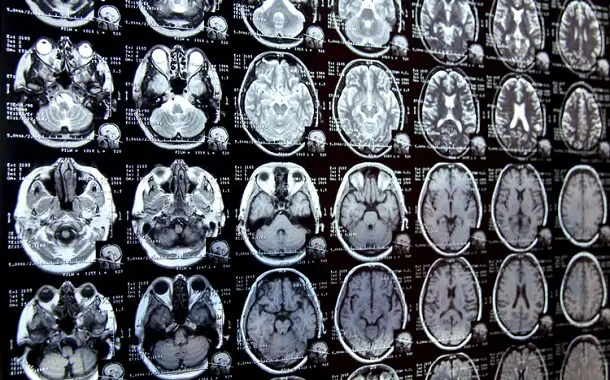 Brain MRI Cost