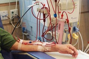 Dialysis Treatment