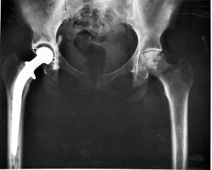 Hip Replacement xray