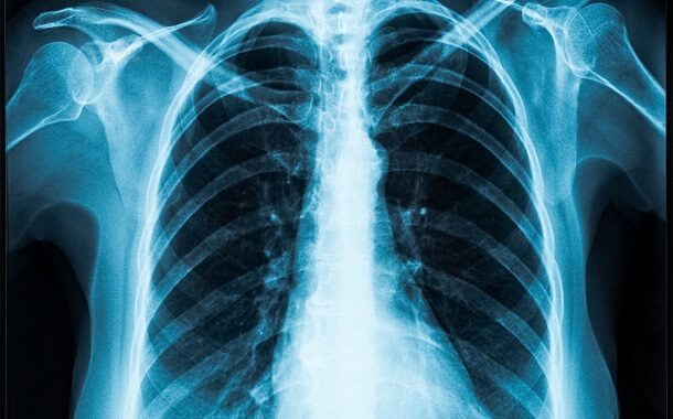 How Much Does A Chest Xray Cost 