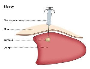 Lung Biopsy