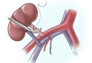 Transplanting a kidney