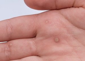 Wart in Hand